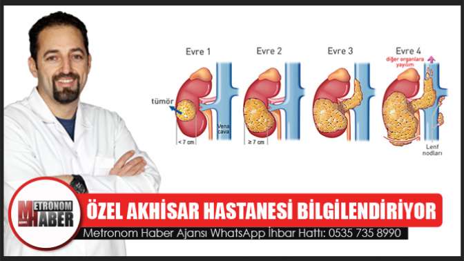 Özel Akhisar Hastanesi Bilgilendiriyor Böbrek Tümörleri